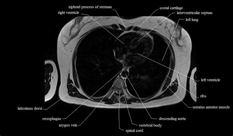 Anatomy of the chest, abdomen, and pelvis was produced in part due to the generous funding of the david f. chest anatomy | MRI chest (thorax)axial anatomy | free cross sectional anatomy