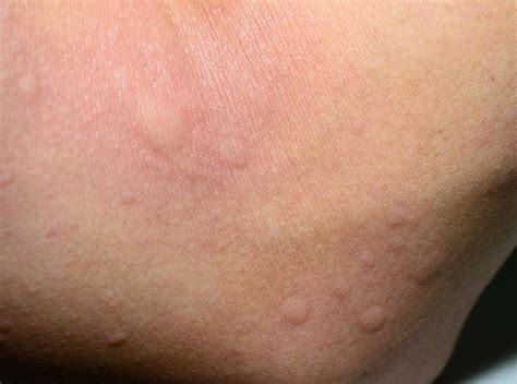 We did not find results for: Symptoms of an Iodine Allergy | Livestrong.com