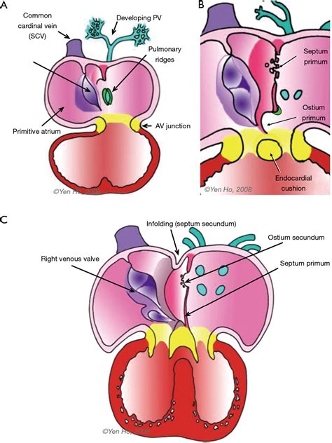 Anatomy Of The Atrial Septum And Interatrial Communications Naqvi