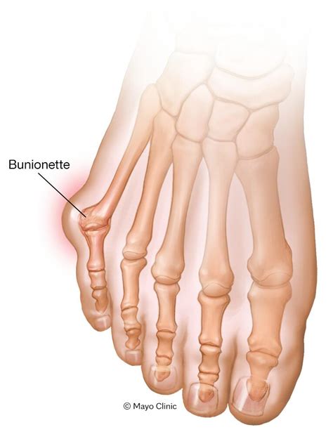 Bunions Symptoms Causes Mayo Clinic