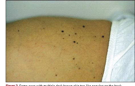 Figure 1 From Skin Tags As A Presenting Sign Of Basal Cell Nevus