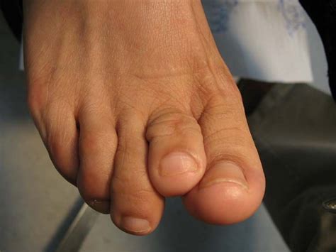This Patient Had A Poor Result After Hammer Toe Surgery Hammer Toes