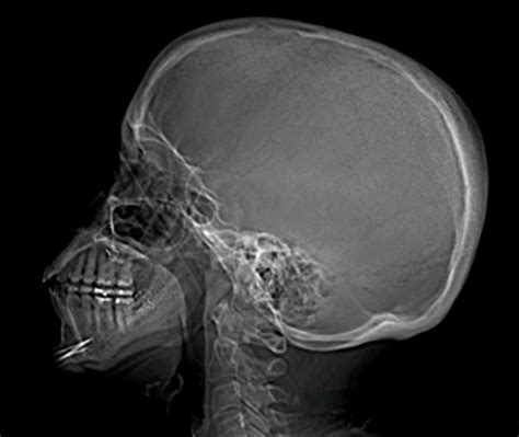 Normal Skull X Ray Lateral View Edoctoronline