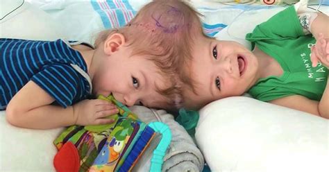 Conjoined Twins Separated After 27 Hour Surgery Growing Stronger
