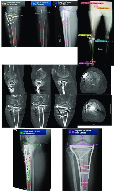 Case Of A 54 Year Old Female With Intra Articular Malunion Of The