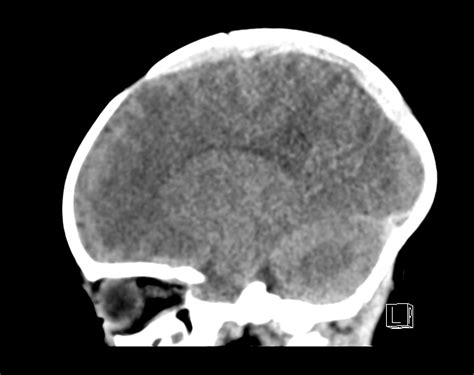 Bilateral Subdural Hemorrhage And Parietal Skull Fracture Image