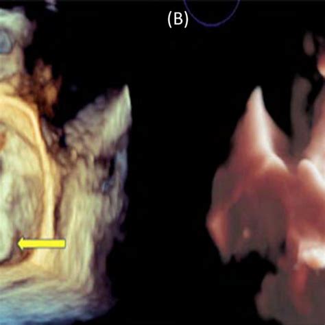 A Dimensional D Enface View Of The Mitral Valve MV With The Download Scientific