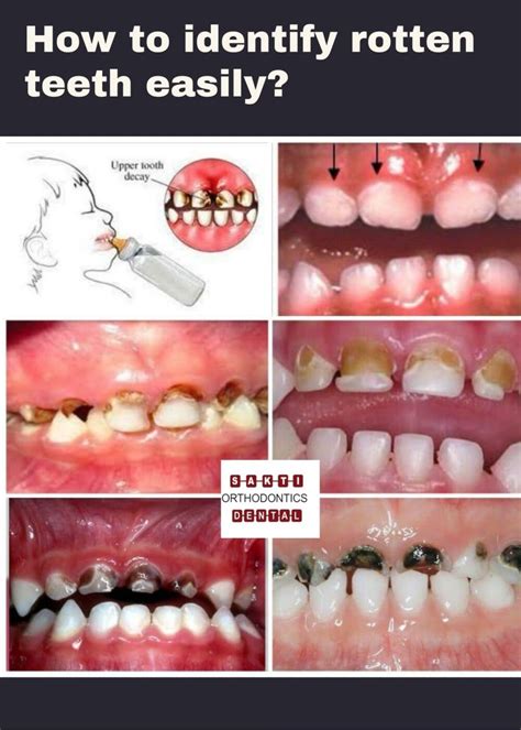 How To Identify Rotten Teeth Easily Without Meeting A Dentist Sakti
