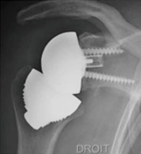 Stemless Reverse Shoulder Arthroplasty Indications Technique And