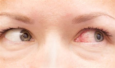 Red Veins In Eyes Causes And Treatment