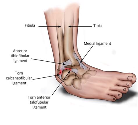 Ankle Sprains City Osteopathy