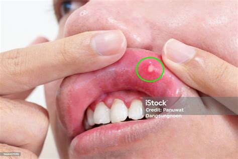 Mouth Ulcer Sore Or Aphthous Stomatitis Oral Health And Medical