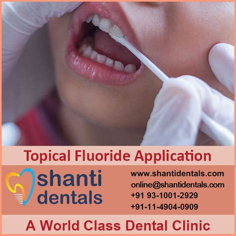 Topical Fluoride Application Shanti Dentals