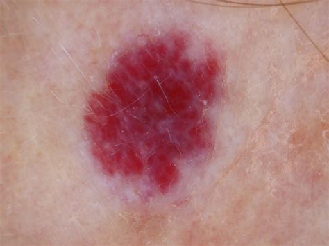 Cherry angiomas are sometimes referred to as senile angiomas, or campbell de morgan spots, and they are very much related to aging. cherry hemangioma causes - pictures, photos