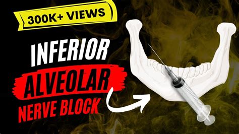 Inferior Alveolar Nerve Block Youtube