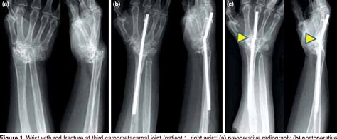 Figure 1 From Total Wrist Arthrodesis With Wrist Fusion Rod In Patients