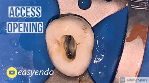 Access Opening Of Maxillary Premolar Youtube