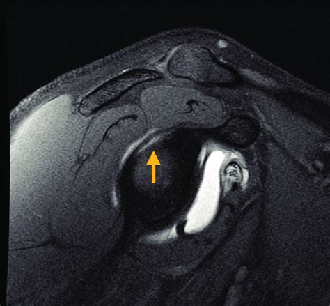 Sagittal T1 Weighted Magnetic Resonance Arthrography Image With Fat