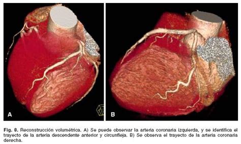 Tomografía Computada Multidetector De Arterias Coronarias Estado Del