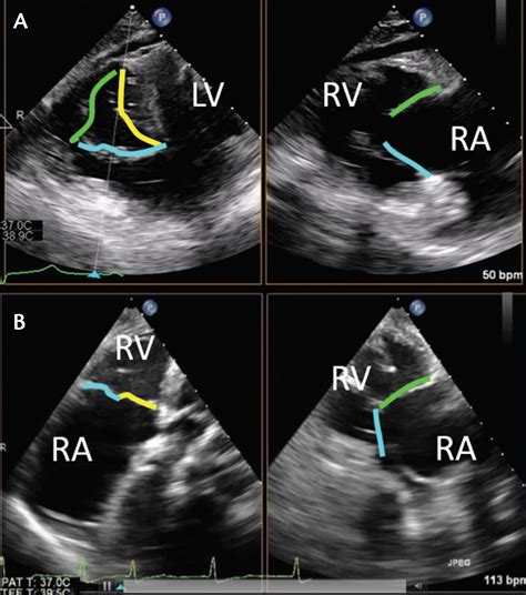 Cardiac Interventions Today Imaging Considerations For Percutaneous