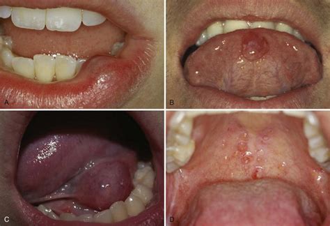 12 Inflammatory Salivary Gland Disorders Pocket Dentistry