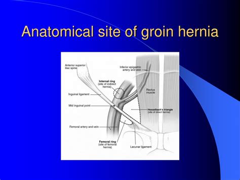 Ppt Hernia Powerpoint Presentation Free Download Id146941