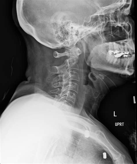 Cervical Spine Imaging In Trauma