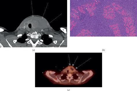 Figure 1 From A Case Of Aggressive Multiple Myeloma With Extramedullary