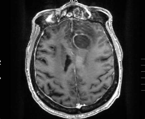 Cases And Images In Infectious Disease Brain Abscess