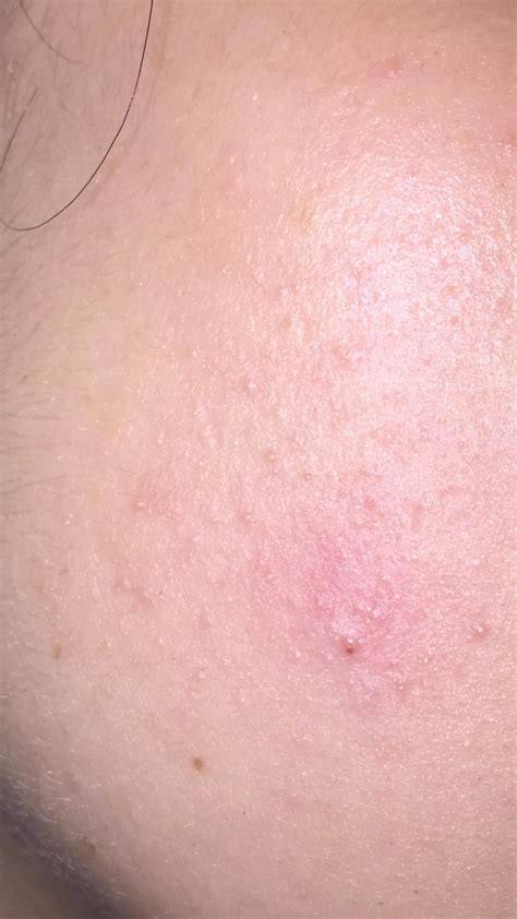 What Are These Tiny White Bumps On My Cheeks More Info In Comments