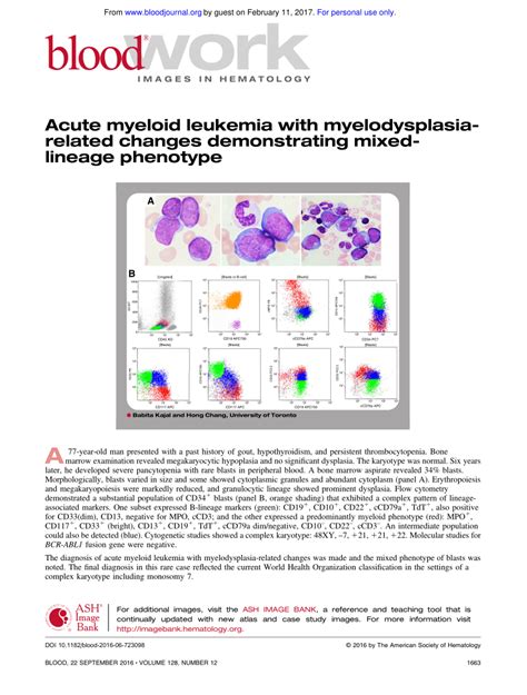Pdf Acute Myeloid Leukemia With Myelodysplasia Related Changes