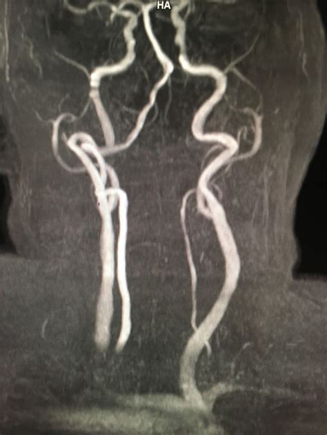Left Vertebral Artery Thrombosis Radiology Imaging Vertebral Artery
