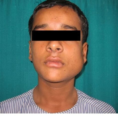 Clinical Picture Of Patient With Swelling Over Left Parotid Region