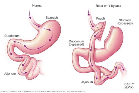 Dumping Syndrome Symptoms And Causes Mayo Clinic