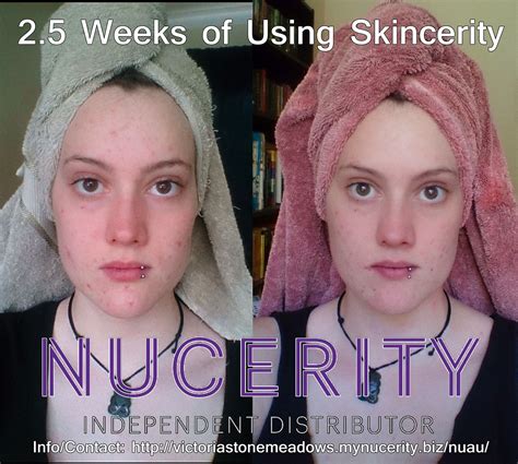 Amazing Transformation Of My Own Skin After Just 2 And A Half Weeks Of Using Skincerity
