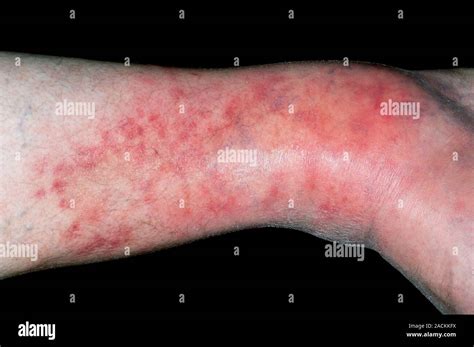 Red And Inflamed Shin Of The Leg In A 53 Year Old Male Patient Showing