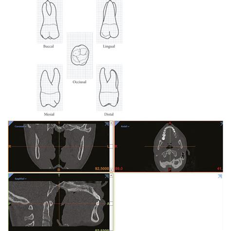 A Maxillary Right First Molar Grid 1 Sq·mm Ct Scan Images B