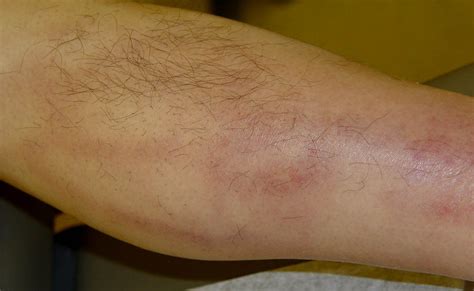 Phlebitis Early Stages Pictures 14 Photos And Images