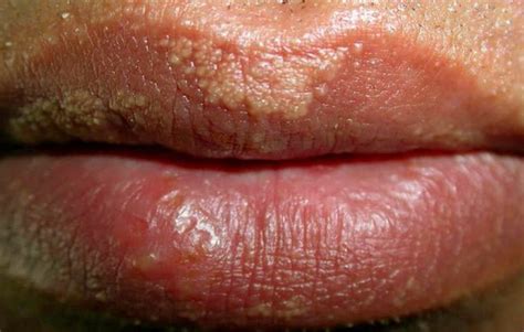 Water Blisters On Lip Pictures Photos