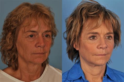 Best Facelift Neck Lift Plastic Surgeon In Toronto Ford Plastic Surgery