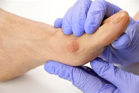 Bunion Surgery Complications And Recovery Time Emedihealth