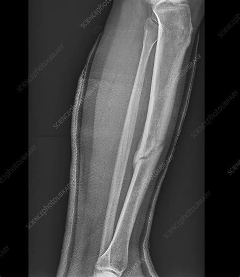 Healing Fractured Leg X Ray Stock Image C0486778 Science Photo