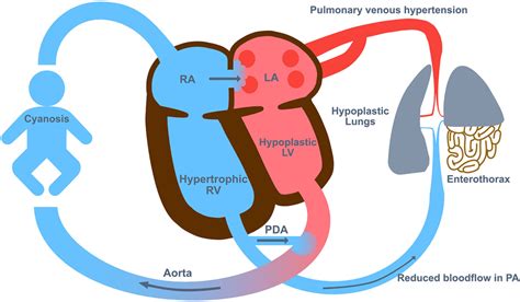 The Pathophysiology In Congenital Diaphragmatic Hernia Cdh The