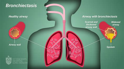 Bronchiectasis St Vincents Lung Health