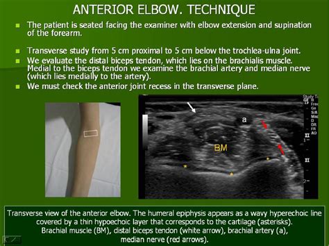 Figure 20 From Ultrasound Of The Elbow What The Radiologist Should