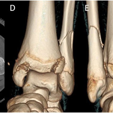 Case 6 A Ap Radiograph Showed Distal Fibular Fracture And Mmf