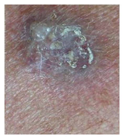 A A Superficial Basal Cell Carcinoma From The Back Of A Woman At