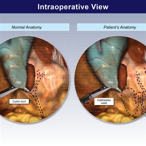 Intraoperative View Comparison Trialexhibits Inc
