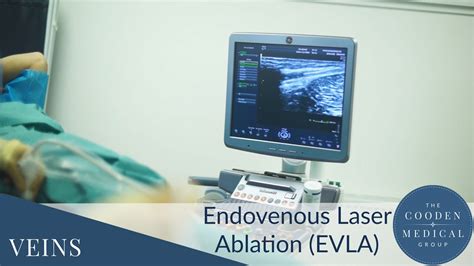 Endovenous Laser Ablation Evla Treatment The Cooden Medical Group