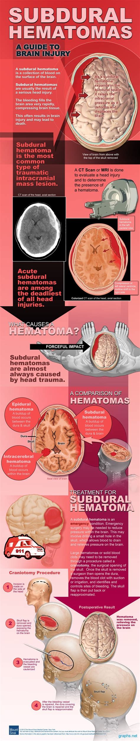 Subdural Hematoma Causes And Treatment Infographics By
